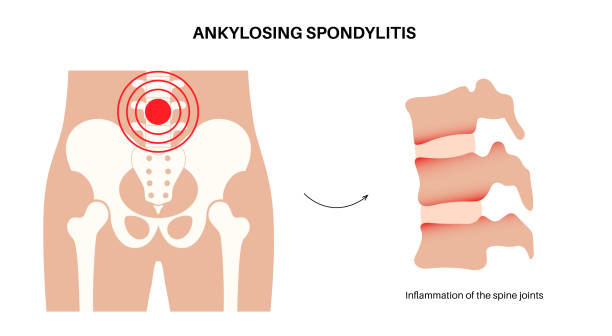 Best Ankylosing Spondylitis Doctor in Ghodbunder Road