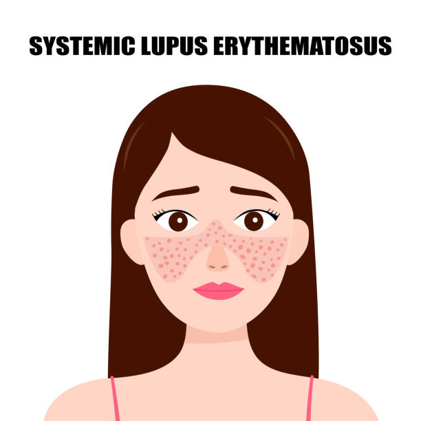 Best Systemic Lupus Treatment Doctor in Ghodbunder Road